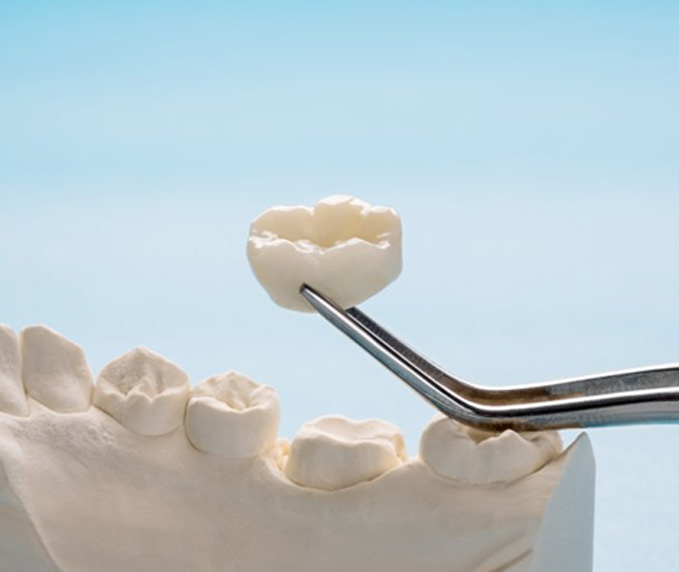 Close up of tweezers holding a dental crown near a plaster model