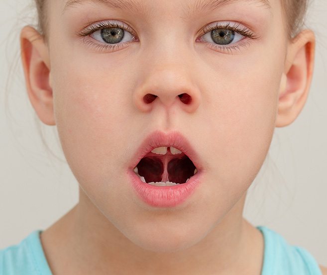 Young girl with a tongue-tie
