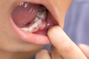 Child opening mouth to show tooth with cavity