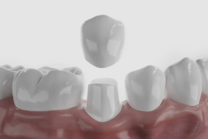 Zirconia dental crown being attached to lower tooth
